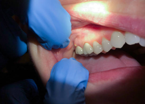 Best Emergency Dental Care for Abscessed Tooth in Miamitown, OH