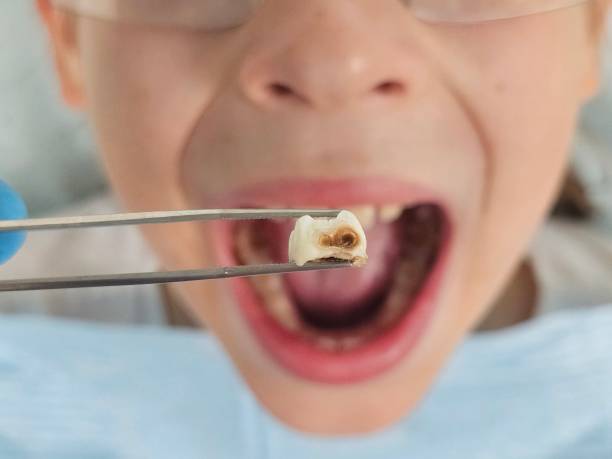 Best Emergency Dentist for Lost Fillings or Crowns in Miamitown, OH